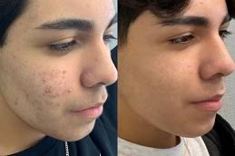✨ كريم Pure White Gold لتفتيح البشرة و إزالة البقع ✨ معاها هدية مجانية - Image 3